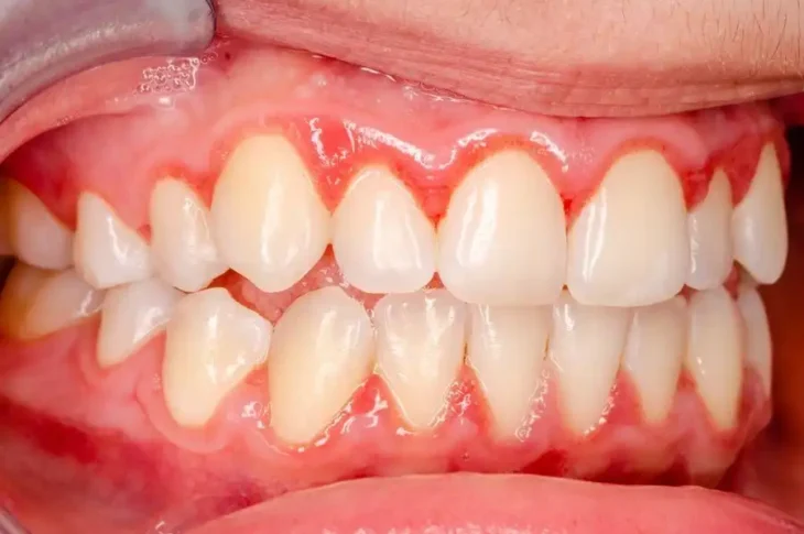 Medical Triggers Behind Pruritus in the Gingival Tissue