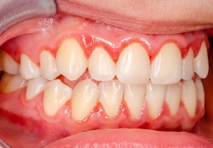 Medical Triggers Behind Pruritus in the Gingival Tissue