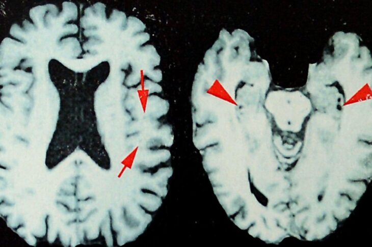 At least 25% of NFL players who died between 2016 and 2021 had CTE