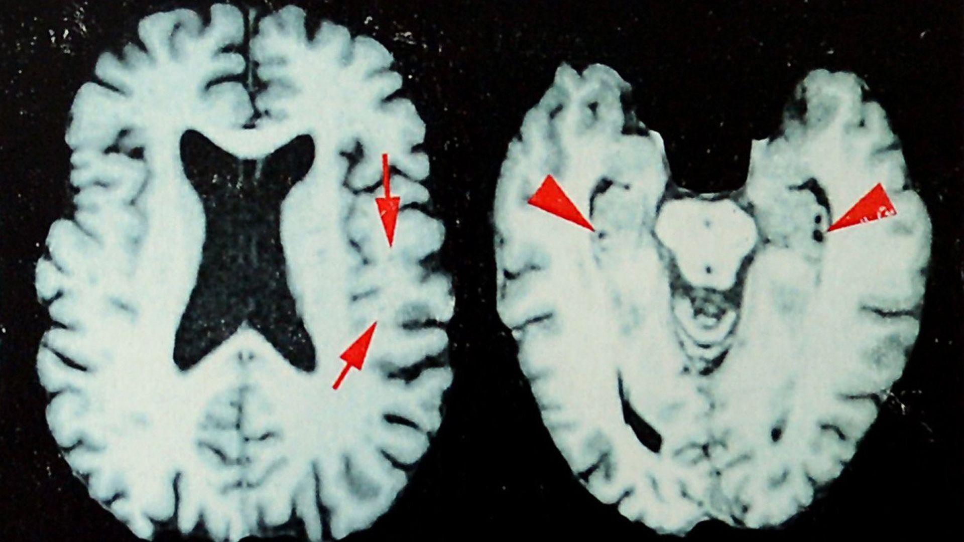 At least 25% of NFL players who died between 2016 and 2021 had CTE